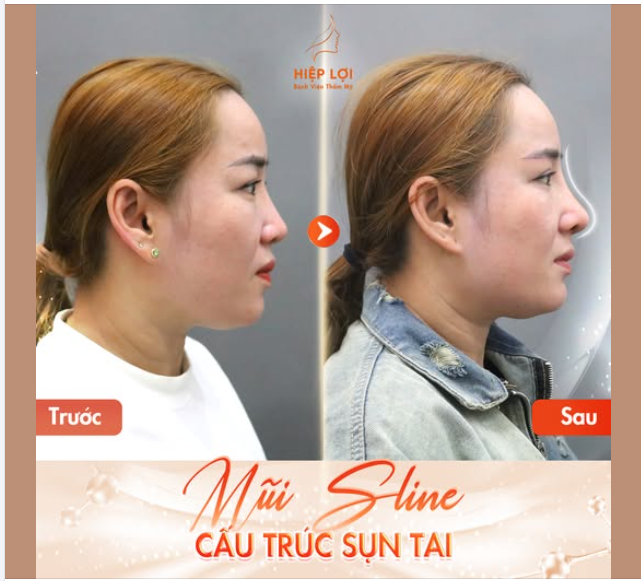 HÌNH ẢNH TRƯỚC SAU NÂNG MŨI SLINE CẤU TRÚC SỤN TAI - 7 NGÀY BIẾN ĐỔI ẤN TƯỢNG!