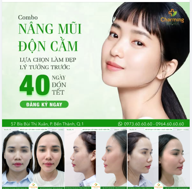 COMBO ĐỘN CẰM KẾT HỢP NÂNG MŨI LÓT SỤN – LỰA CHỌN LÀM ĐẸP LÝ TƯỞNG TRƯỚC TẾT