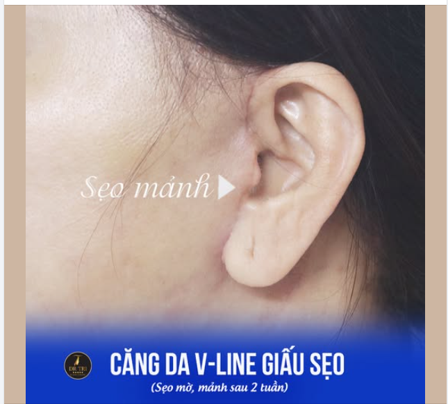 Khách nói: "Tin tưởng Bác Trí vì thấy bạn bè căng da VLine ai cũng mờ sẹo mờ sau 2 tuần"