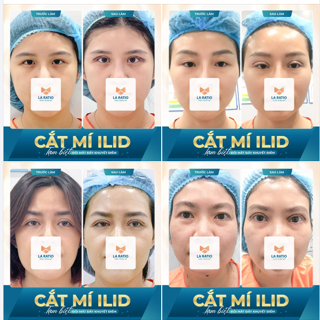 CẮT MÍ ILiD - TẠM BIỆT ĐÔI MẮT ĐẦY KHUYẾT ĐIỂM