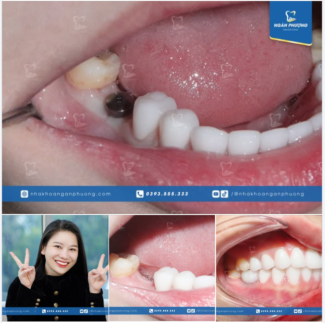 Làm sứ và phục hình implant đã giúp Mai Huyền có được nụ cười mơ ước và răng miệng khỏe mạnh.