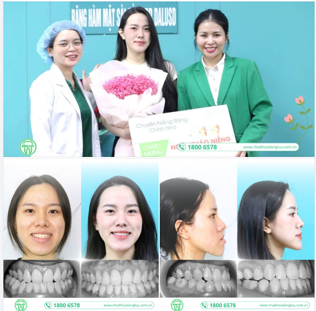 THÁO NIỀNG, CHECK!!! ​​​​​​​  Chúc mừng Tân Tháo Niềng-er: Hồg Hạnh