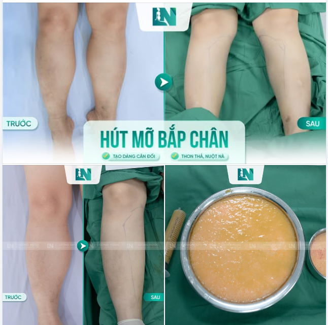 HÚT MỠ THU GỌN BẮP CHÂN TO