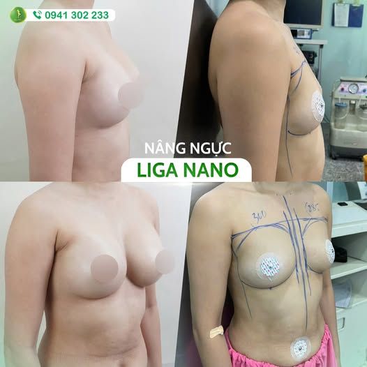 FEEDBACK SIÊU PHẨM NÂNG V1 LIGA NANO