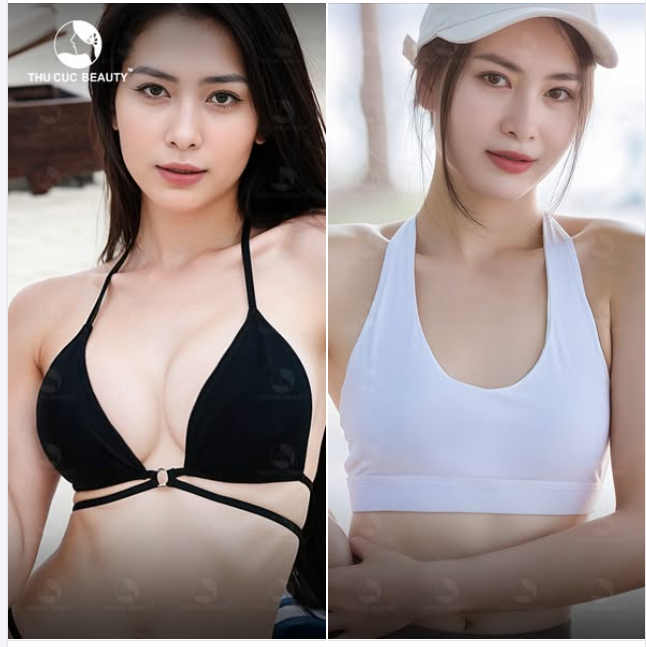 Lựa chọn size túi ngực thích hợp với hình dáng cơ thể là khâu quan trọng để có vòng 1 như ý