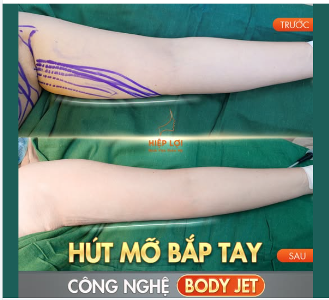Mỡ "dưới bắp tay" là một trong những vấn đề khiến nhiều người cảm thấy tự ti, đặc biệt khi diện những trang phục sát nách.