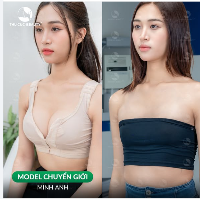 Không còn lo ngại V1 teo lép, bị mọi người body shaming Chọn Ngực TC 39.9Tr
