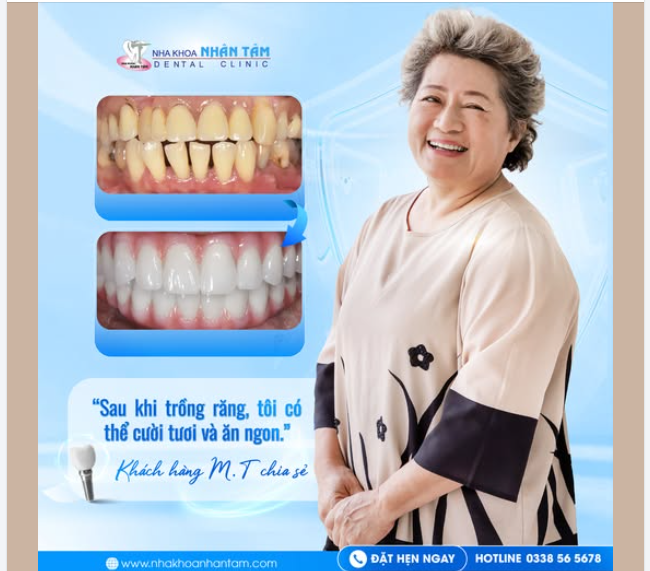 Cô M.T đã từng rất tự ti vì hàm răng trên đã trồng từ lâu, nhưng không được chăm sóc đúng cách, răng dần bị xuống cấp.