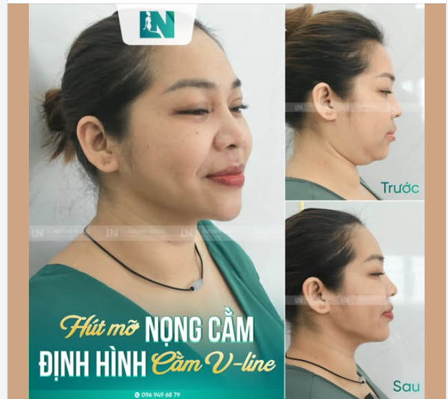 NÂNG CƠ XÓA NỌNG - GƯƠNG MẶT THON GỌN