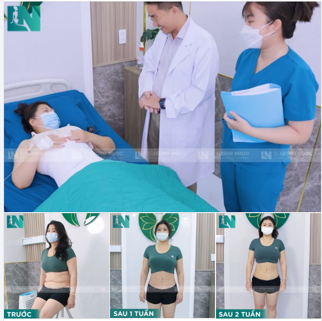 HÀNH TRÌNH “HÚT MỠ SIẾT EO” CỦA CHỊ KHÁCH VIỆT KIỀU