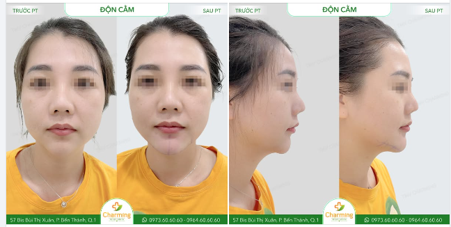 Trước khi đến với TMV Charming, nàng khách sở hữu dáng cằm ngắn và hơi thụt vào khiến khuôn mặt chưa thực sự hài hòa.