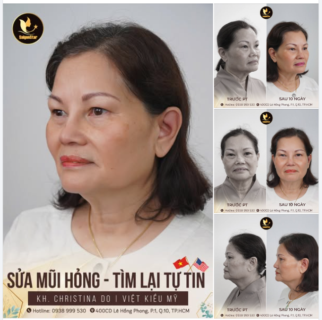 THÀNH CÔNG GIẢI CỨU MŨI HỎNG SAU 4 LẦN NÂNG MŨI CHO CỰU TIẾP VIÊN HÀNG KHÔNG MỸ
