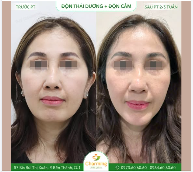 Nhìn vào hình ảnh trước và sau khi nàng khách hàng thực hiện độn thái dương và độn cằm, chúng ta có thể thấy rõ sự thay đổi tích cực.