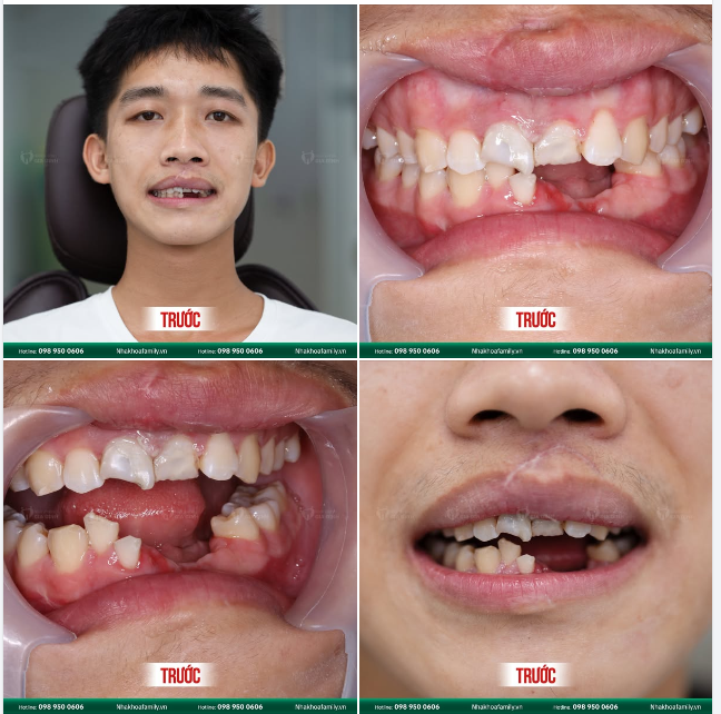 TRỒNG RĂNG IMPLANT CHO CHÀNG TRAI 2K5 MẤT RĂNG DO TAI NẠN