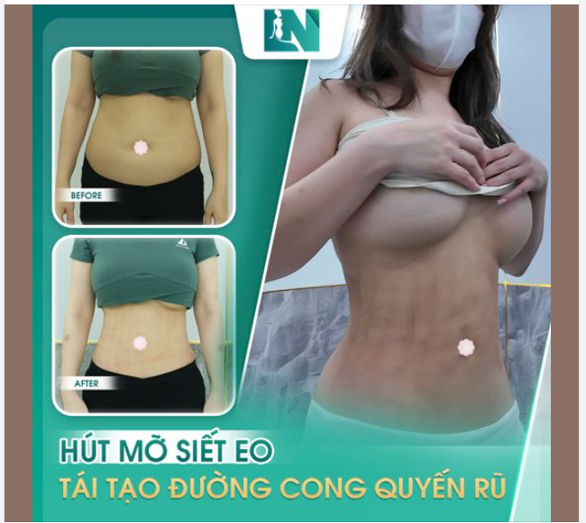 SIÊU PHẨM HÚT MỠ SIẾT EO