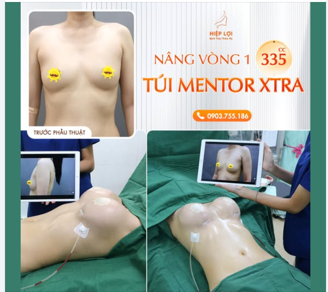KH chia sẻ: Trước khi phẫu thuật, chị khách hàng tự ti vì vòng 1 kém hấp dẫn.