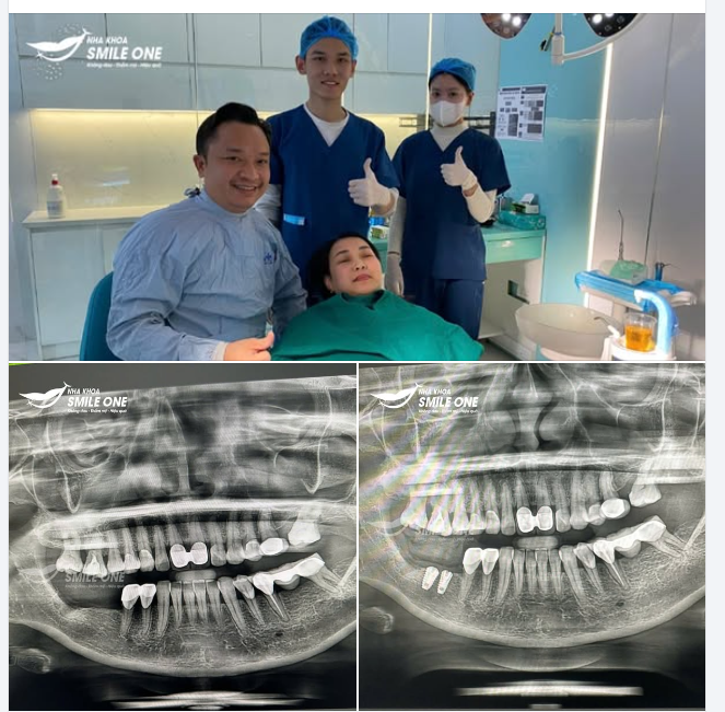 TRỒNG 2 IMPLANT CHO KHÁCH VIỆT KIỀU MỸ