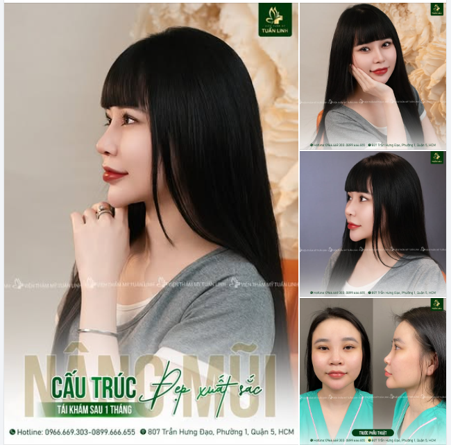 Mũi cấu trúc sau 1 tháng tái khám - Đẹp hoàn hảo tới từng chi tiết!!