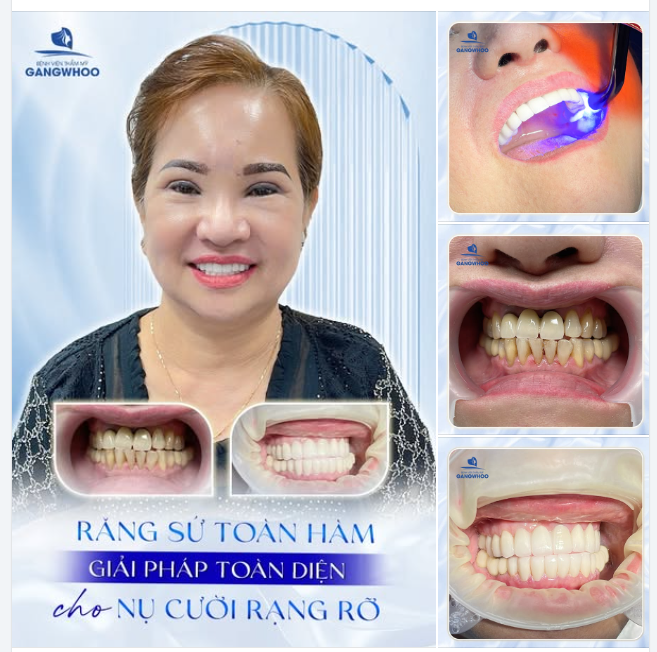 RĂNG SỨ LAVA PLUS - GIẢI PHÁP TOÀN DIỆN CHO NỤ CƯỜI RẠNG RỠ