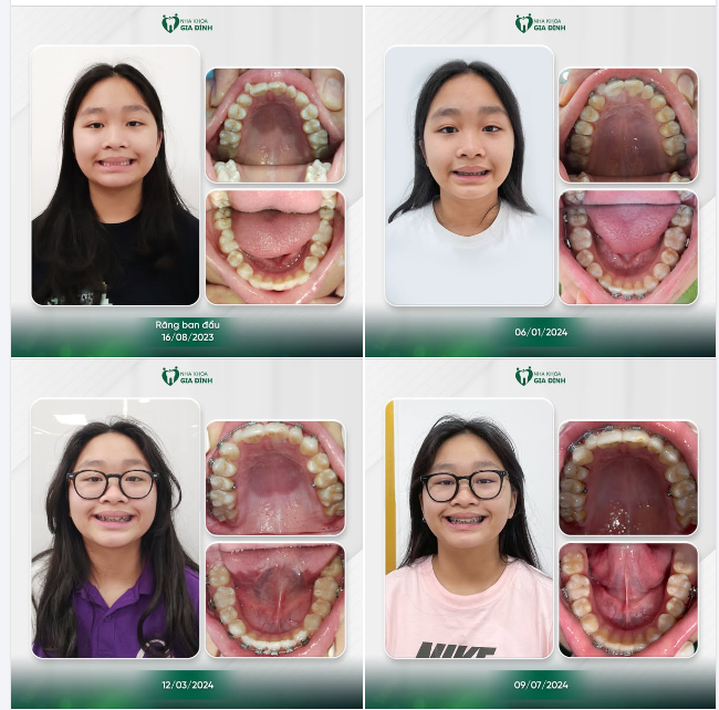 NIỀNG RĂNG CÀNG SỚM, HIỆU QUẢ CÀNG LỚN