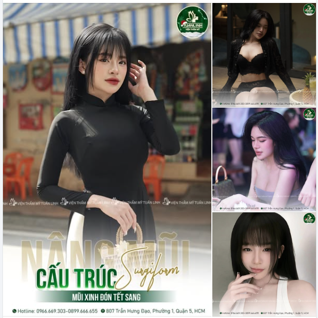 Form mũi hoàn hảo bật thần thái đỉnh cao sau nâng mũi cấu trúc Surgiform