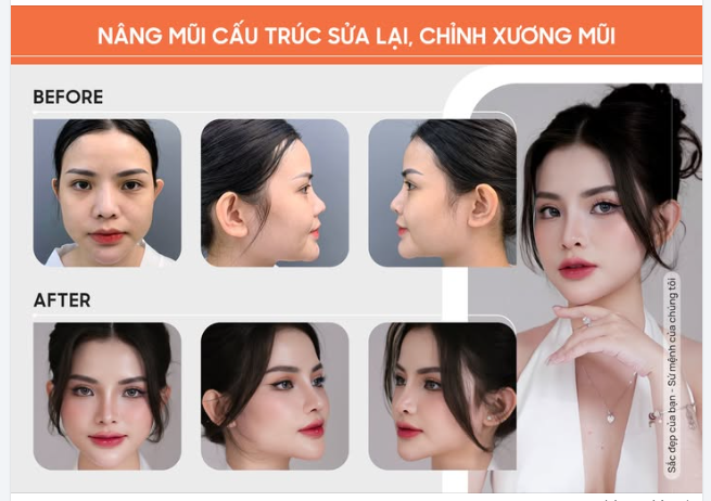 DÁNG MŨI HOÀN HẢO – CHỈNH SỬA TINH TẾ TẠI NAM AN