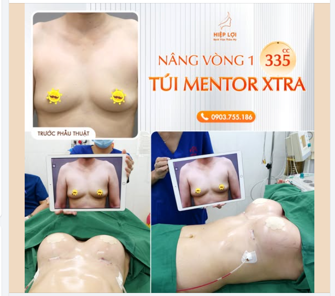 Nâng vòng 1 với túi Mentor XTRA - Size 335CC