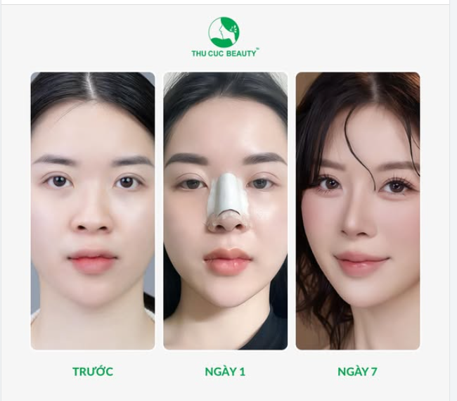 Sau 7 ngày bạn đã có chiếc mũi hoàn hảo