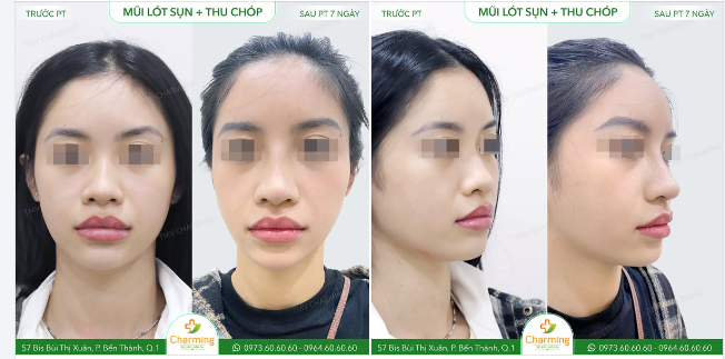 Trước khi đến với TMV Charming, nàng khách sở hữu dáng mũi chưa thực sự thanh thoát, phần chóp mũi hơi to khiến tổng thể gương mặt chưa đạt được sự hài hòa như mong muốn.