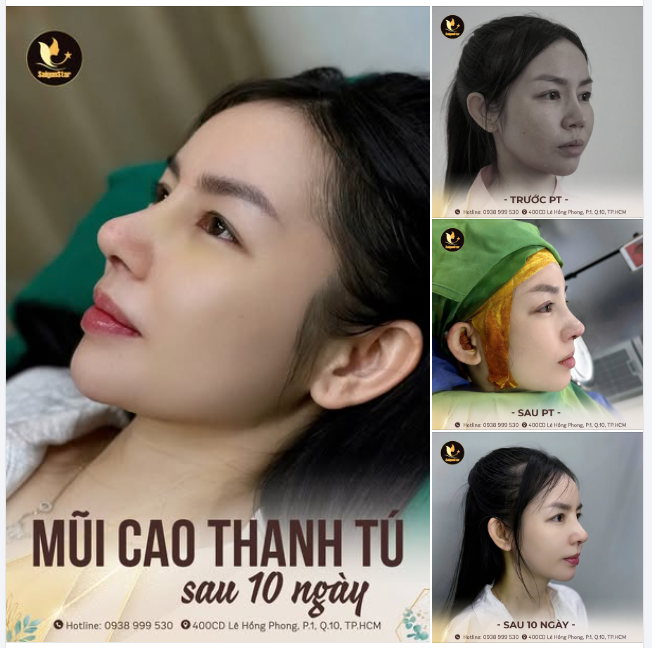 Mũi siêu chuẩn form sau 10 ngày NÂNG MŨI CẤU TRÚC SỬA LẠI, xin mời cả nhà cùng chiêm ngưỡng!!!