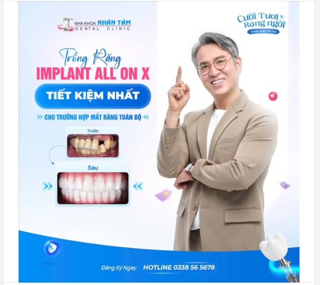 Trồng răng Implant All On X - Giải pháp tiết kiệm nhất cho trường hợp mất răng toàn bộ
