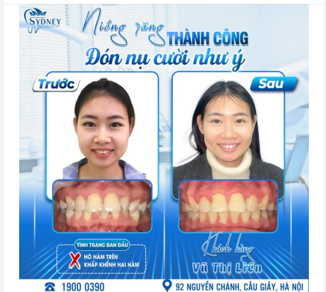 NIỀNG RĂNG THÀNH CÔNG - ĐÓN NỤ CƯỜI NHƯ Ý