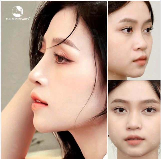 Say "bye" mũi thấp, đầu mũi to cùng Mũi TC 11.9Tr