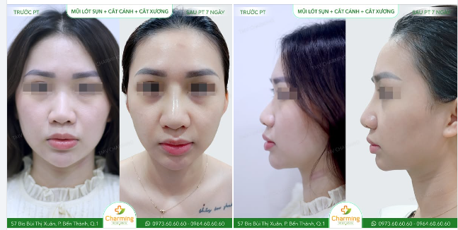 Chỉ sau 7 ngày, khách hàng xinh xắn của chúng ta đã có diện mạo hoàn toàn mới sau khi nâng mũi tại TMV Charming.