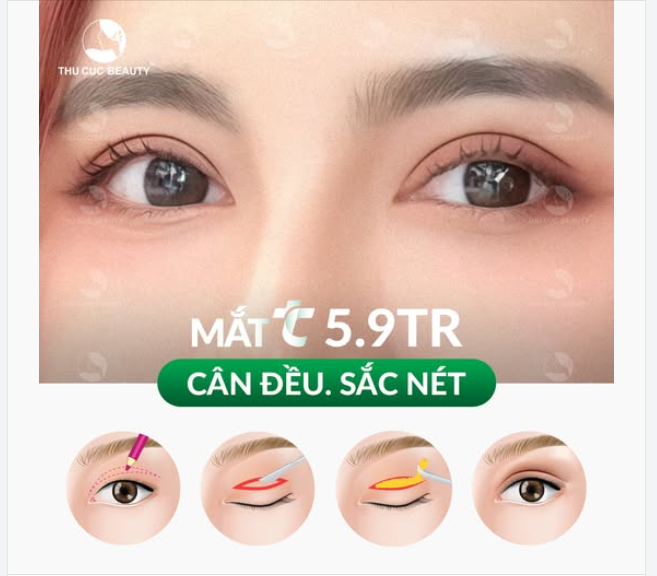 Không còn  khuyết điểm mí: mí sụp, mí lệch, đa nếp mí