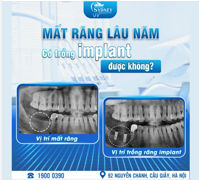 MẤT RĂNG LÂU NĂM CÓ TRỒNG IMPLANT ĐƯỢC KHÔNG?
