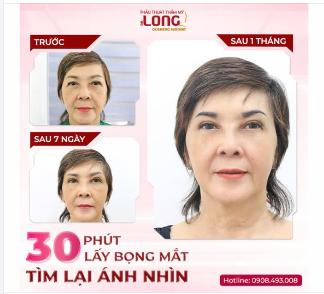 30 PHÚT LẤY BỌNG MẮT TÌM LẠI ÁNH NHÌN