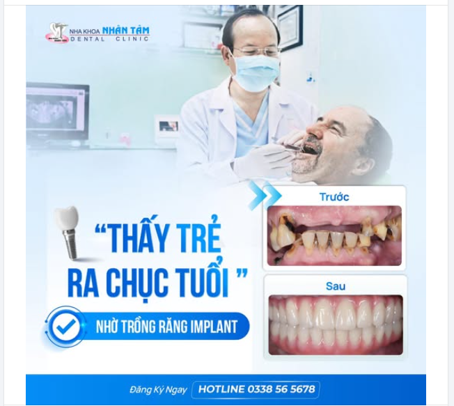 “Thấy trẻ ra chục tuổi nhờ trồng răng Implant”