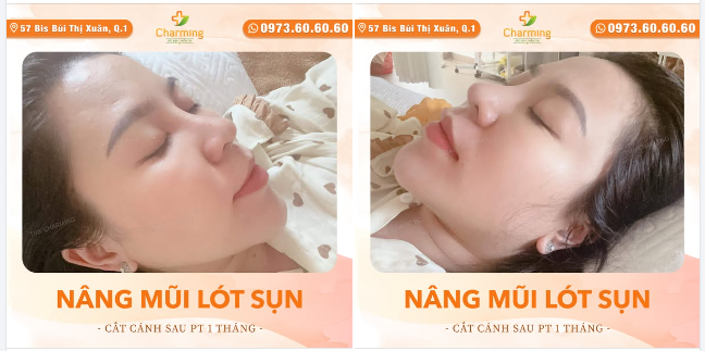 Nàng khách xinh đẹp này đã lựa chọn dịch vụ nâng mũi lót sụn kết hợp với cắt cánh mũi tại TMV Charming, và kết quả đã không làm cô thất vọng chút nào!