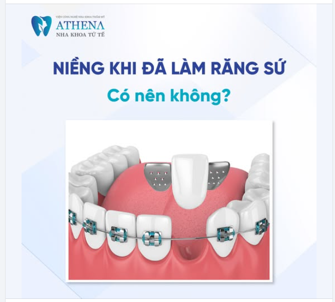 Sự kết hợp giữa răng sứ và niềng răng - Lời khuyên từ chuyên gia