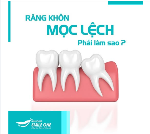 CHIẾC RĂNG KHÔN CỦA BẠN CÓ ĐANG MỌC LỆCH KHÔNG?