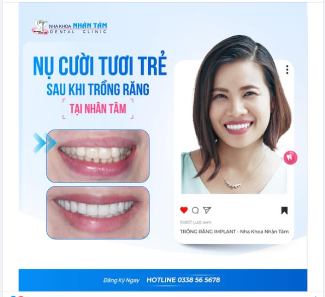 Nụ cười tươi trẻ sau khi trồng răng tại Nhân Tâm