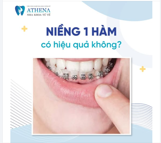 Niềng răng 1 hàm có hiệu quả không?