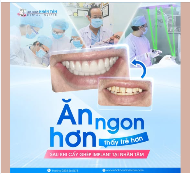 ĂN NGON VÀ TRẺ HƠN NHỜ CẤY GHÉP IMPLANT