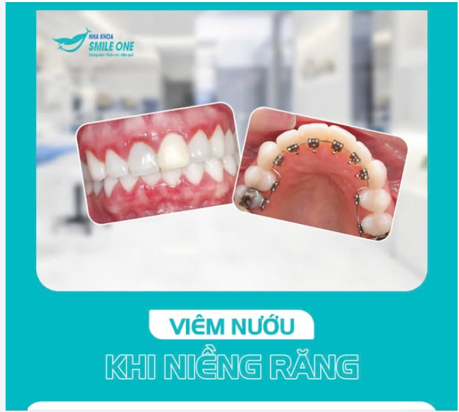 NIỀNG RĂNG CÓ DỄ BỊ VIÊM LỢI KHÔNG?