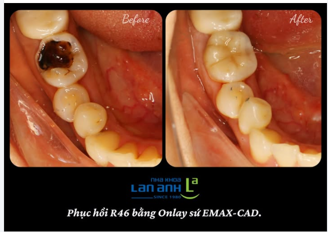 Bạn có răng bị bể vỡ lớn mà chưa xử lý không? Mời bạn tham khảo phục hình răng bằng onlay sứ tại nha khoa Lan Anh nha!