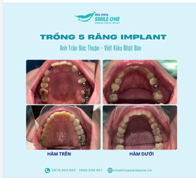 TRỒNG 5 RĂNG IMPLANT PHỤC HÌNH RĂNG MẤT ĂN NHAI NHƯ RĂNG THẬT