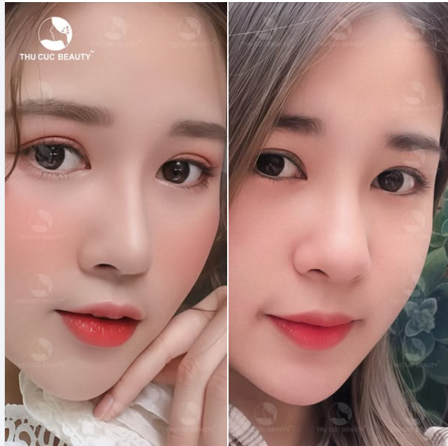 Đừng để mũi to khiến bạn bị "phong ấn" nhan sắc