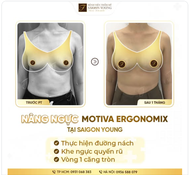 Khách hàng nâng Vòng 1 Motiva Ergonomix tại Saigon Young