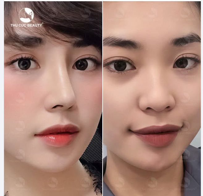 Chiếc mũi cao làm khuôn mặt thanh tao sáng đẹp